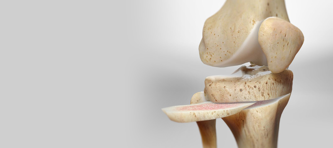 High Tibial Osteotomy: Procedure And Recovery